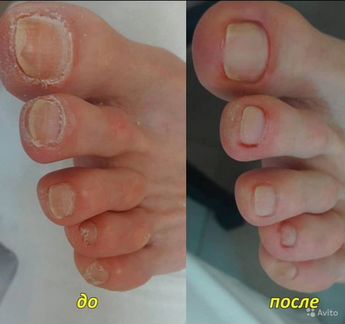 Медицинский педикюр подолог