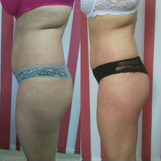 Антицеллюлитный вакуумный массаж, RF лифтинг